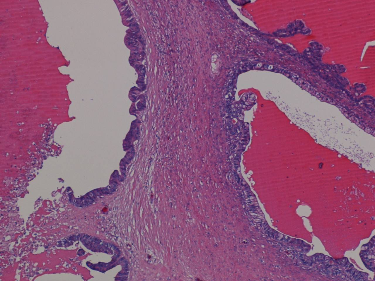 Imagen de Tumores en colon y ovario / Tumors in colon and ovary.