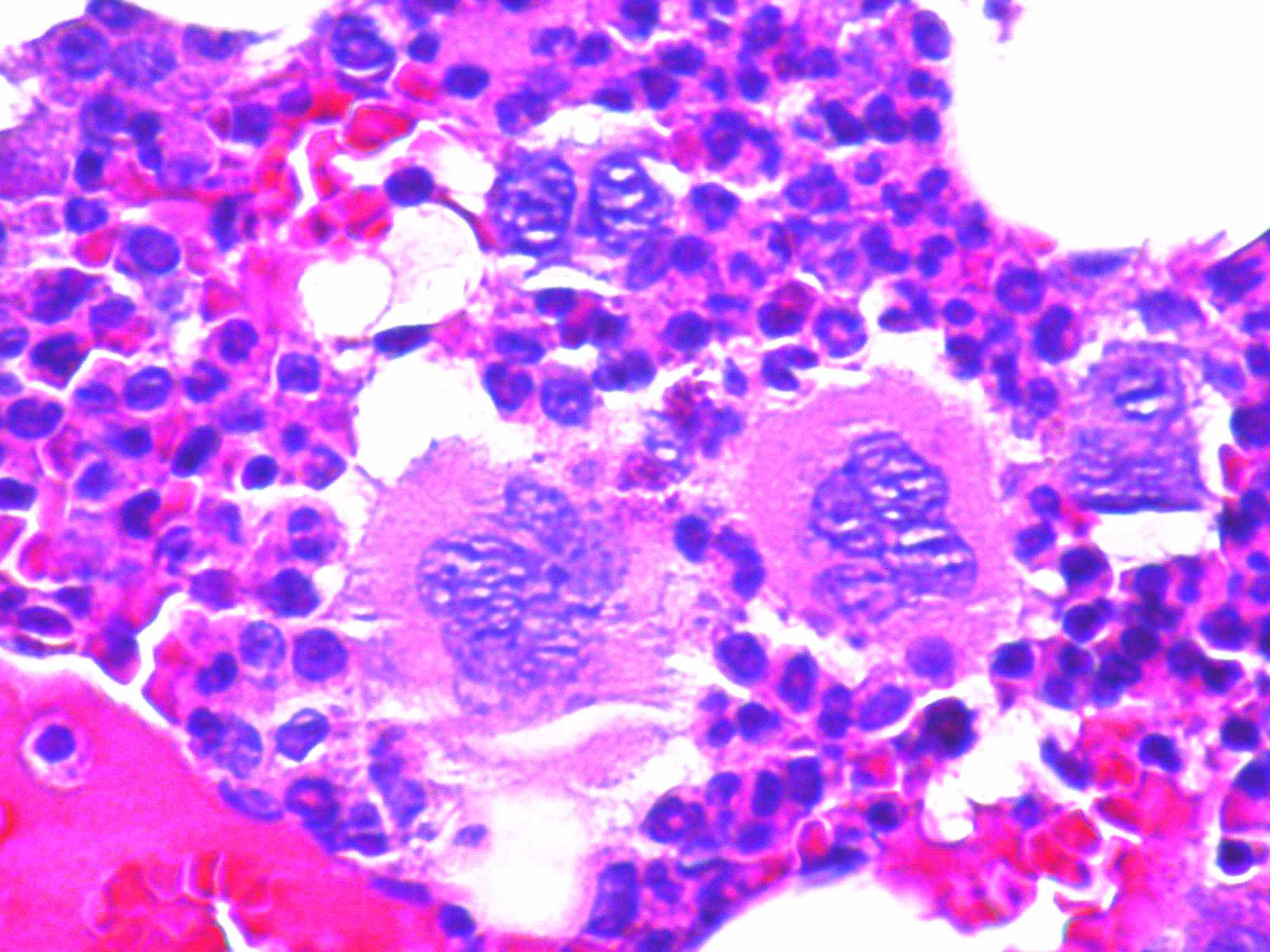 Imagen de Trombocitosis de dos años de evolución en paciente femenina adulta joven /  Adult female with thrombocytosis evolving for two years.