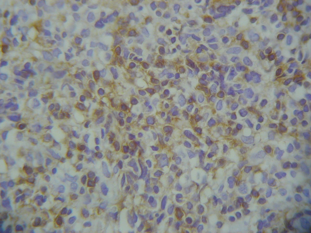 Imagen de Tumor mediastínico en mujer de 35 años / Mediastinal tumor in 35 y-o female.