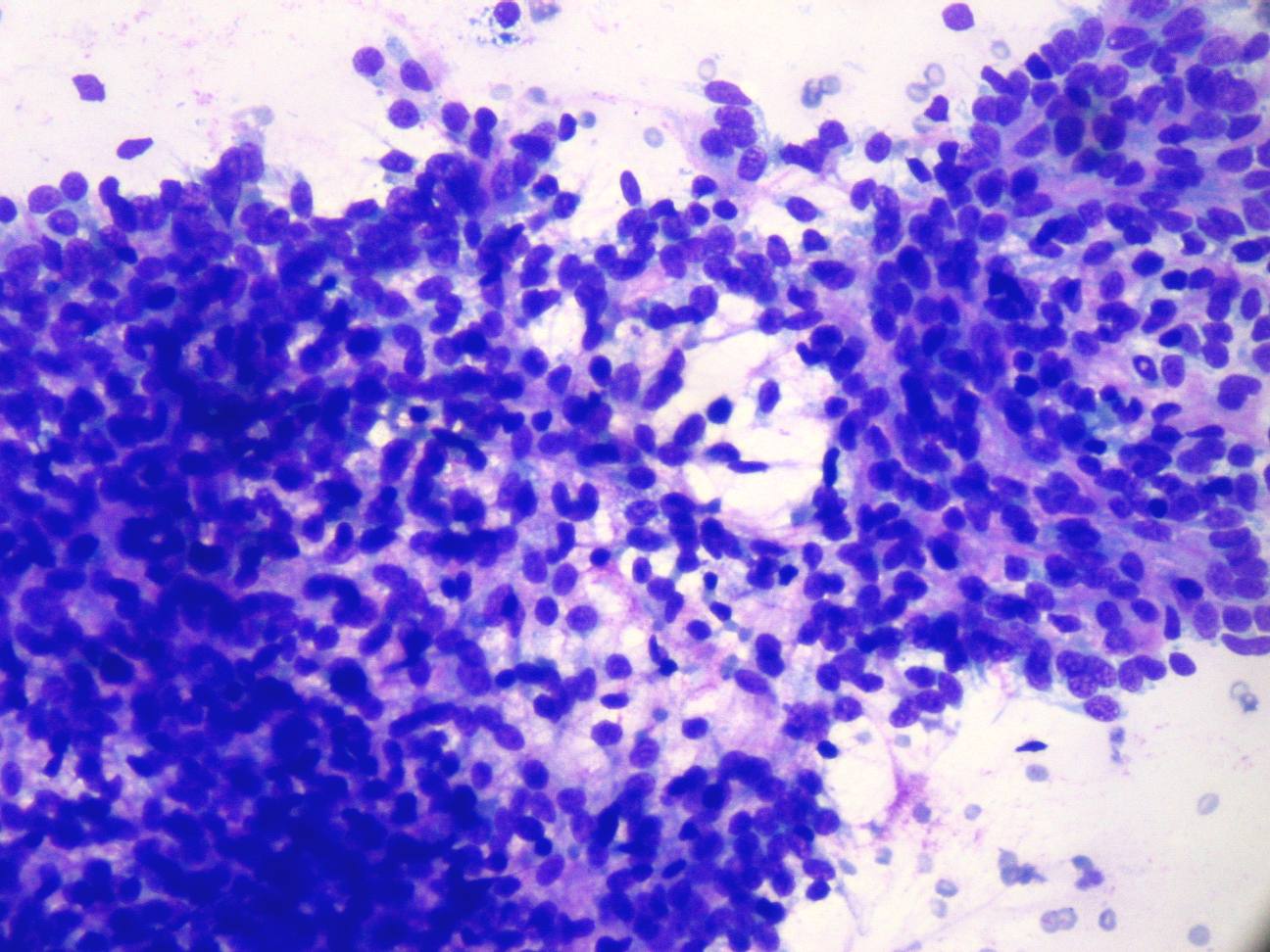 Imagen de Tumor renal en nio de 2 aos / Kidney tumor in 2 y-o child