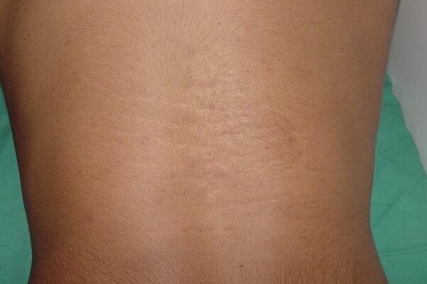 Imagen de Lesiones cutneas en la espalda de 10 aos de evolucin