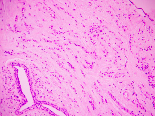 Imagen de Microlegrado endometrial en mujer frtil con metrorragia / Endometrial microcuretting in fertile female with metrorrhagia.