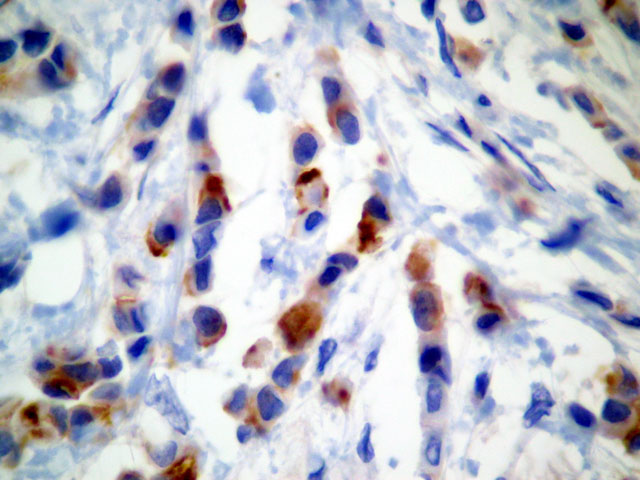 Imagen de Microlegrado endometrial en mujer frtil con metrorragia / Endometrial microcuretting in fertile female with metrorrhagia.