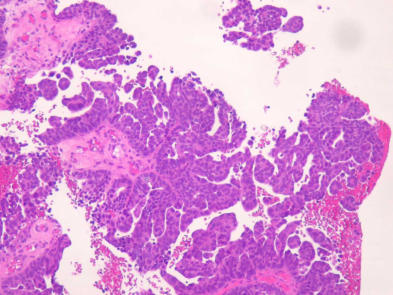 Imagen de Citologa crvico-vaginal en base lquida en mujer de 83 aos  / Cervical-vaginal liquid base citology in 83 year old female.