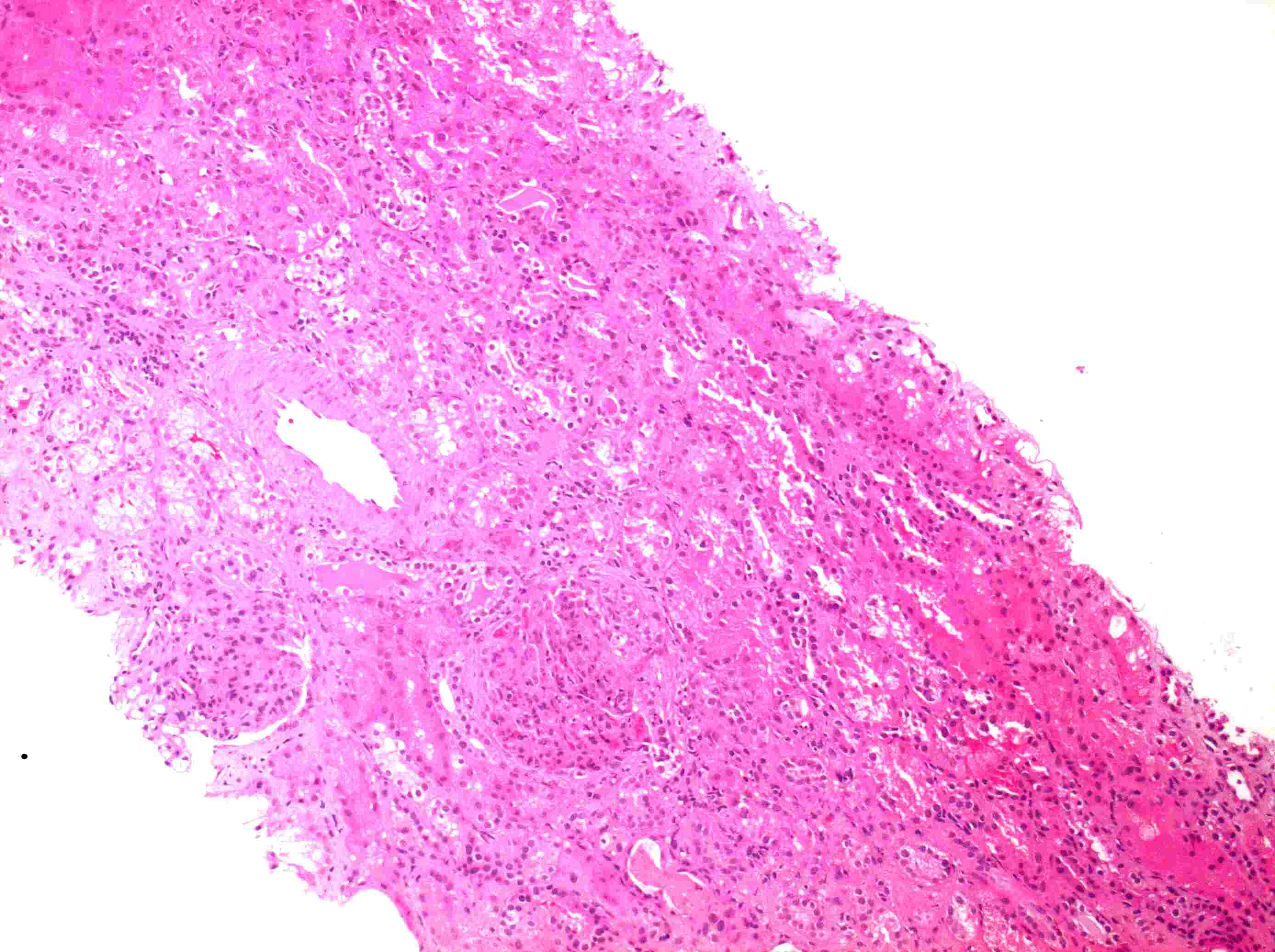 Imagen de Deterioro de la funcin renal en varn de 32 aos / 32 y-o male with renal function impairment. 