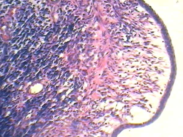 Imagen de Tumor renal izquierdo en nio de 5 aos / Left kidney tumor in 5 y-o child.