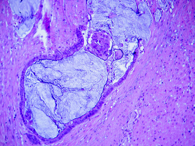 Imagen de Tumoracin plvica en mujer perimenopusica / Pelvic tumor in perimenopausal female.