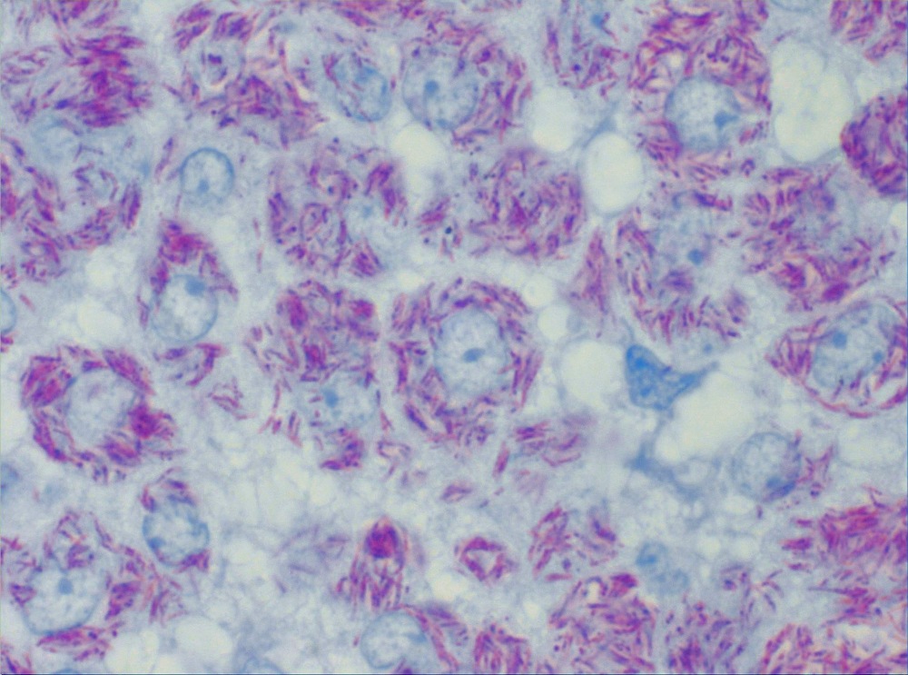 Imagen de Ganglio linftico mesentrico en paciente VIH / Mesenteric lymph node in HIV patient.