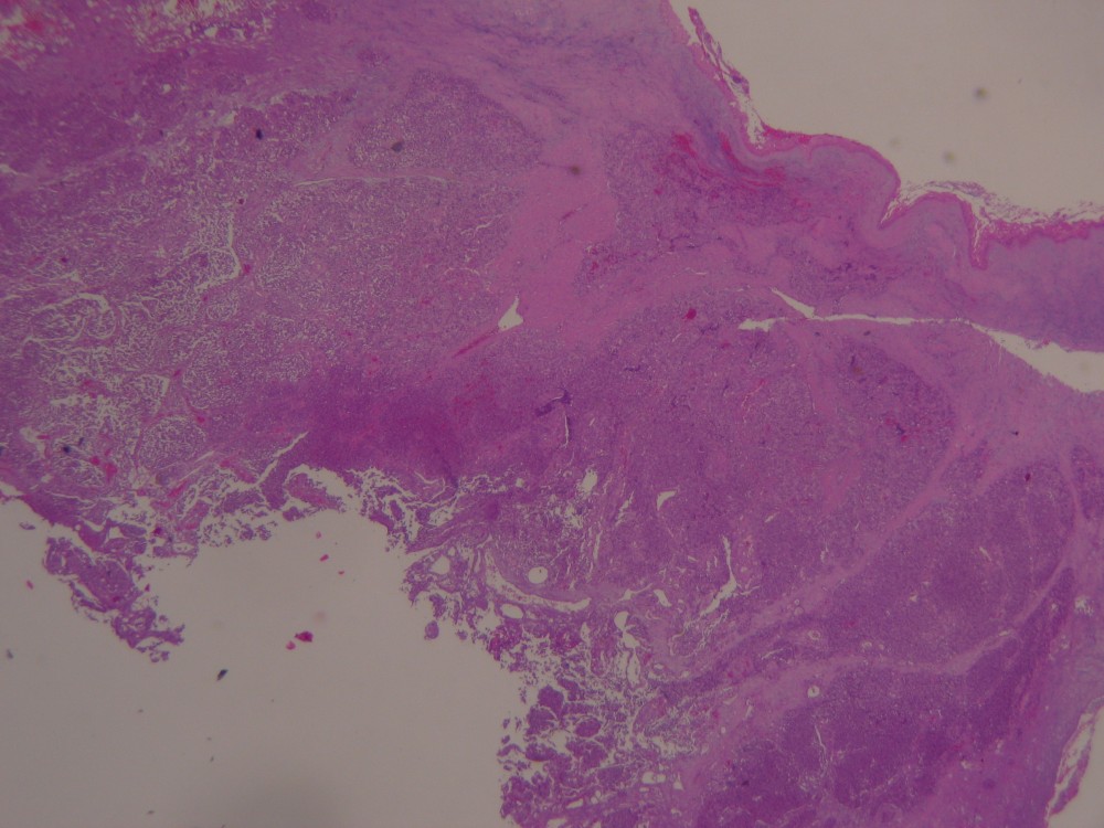 Imagen de Ndulo larngeo en varn de 42 aos/Laryngeal nodule in 42 y-o male.