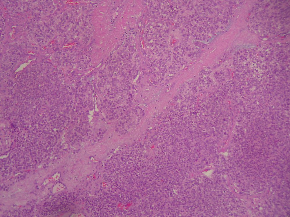 Imagen de Ndulo larngeo en varn de 42 aos/Laryngeal nodule in 42 y-o male.