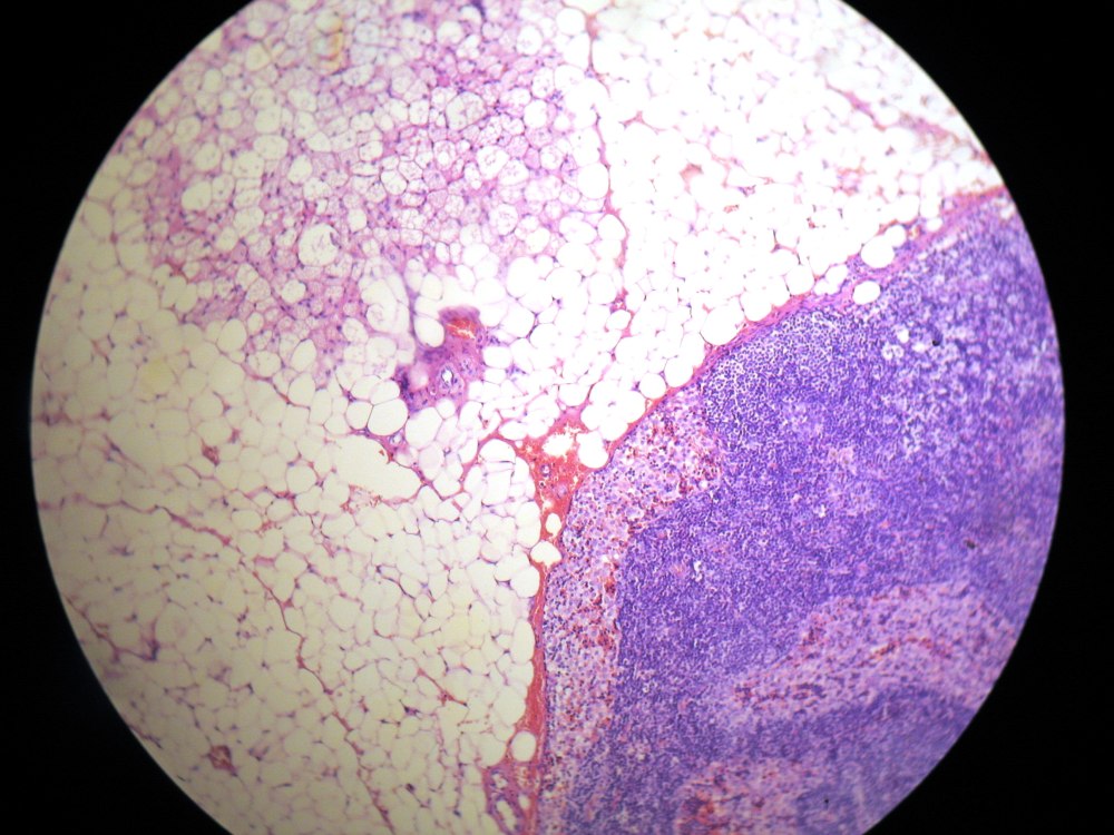 Imagen de Biopsia ganglionar en paciente con sospecha de recidiva de linfoma de Hodgkin/Lymph node biopsy in patient suspicious for relapse of Hodgkin's lymphoma.