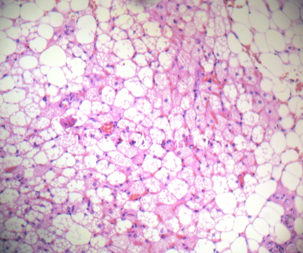 Imagen de Biopsia ganglionar en paciente con sospecha de recidiva de linfoma de Hodgkin/Lymph node biopsy in patient suspicious for relapse of Hodgkin's lymphoma.