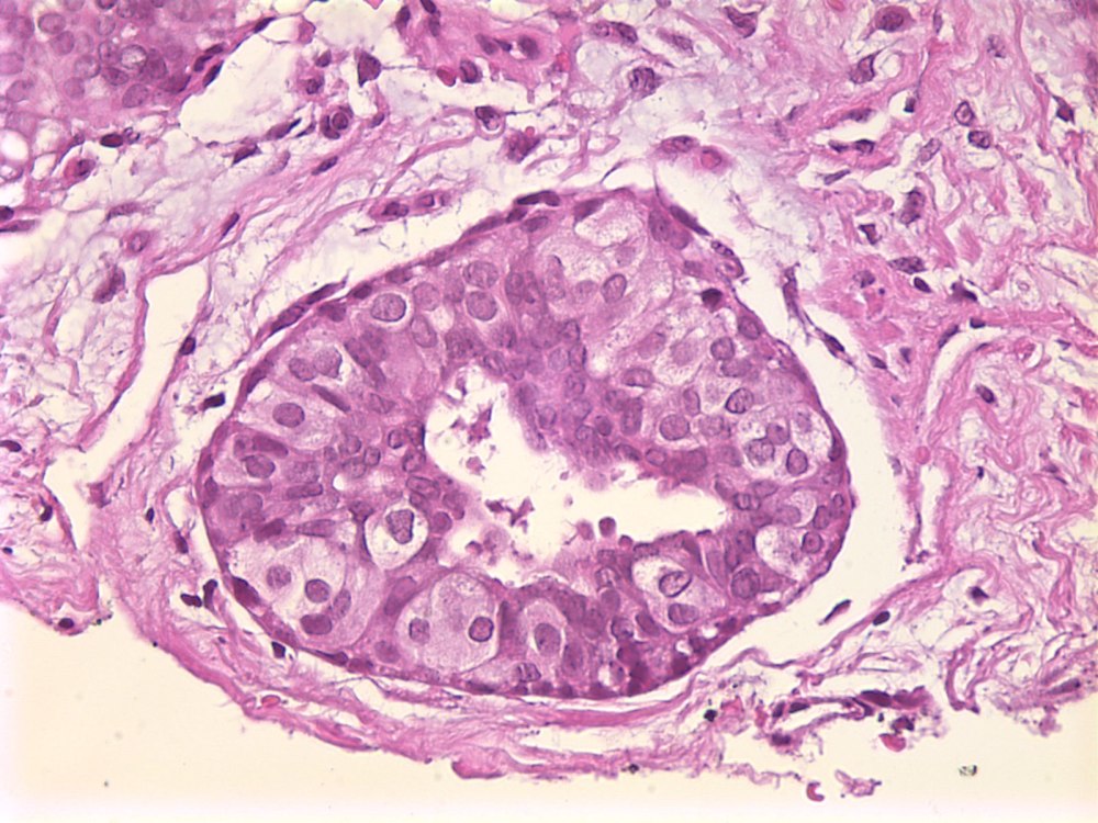 Imagen de Ndulo mamario en mujer de 18 aos/Breast nodule in 18 y-o female.