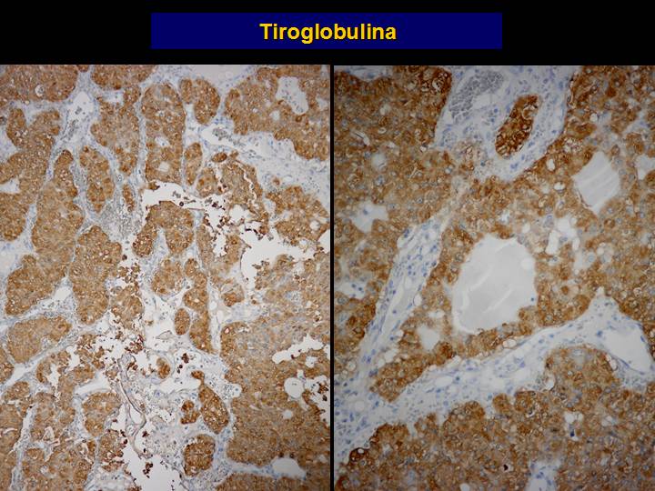 Imagen de Tumor en regin escapular derecha/Tumor in right scapular area.