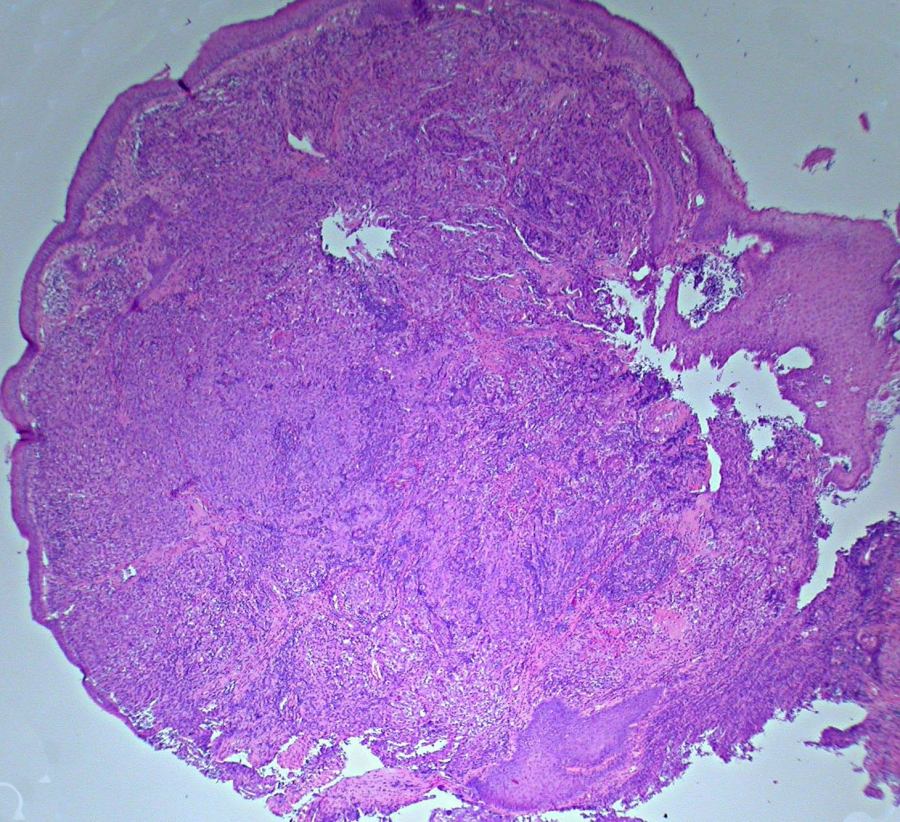Imagen de Enlarged left palatine tonsil.