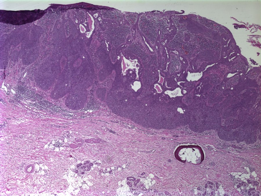 Imagen de Lesión verrucosa en antebrazo / Warty forearm lesion.