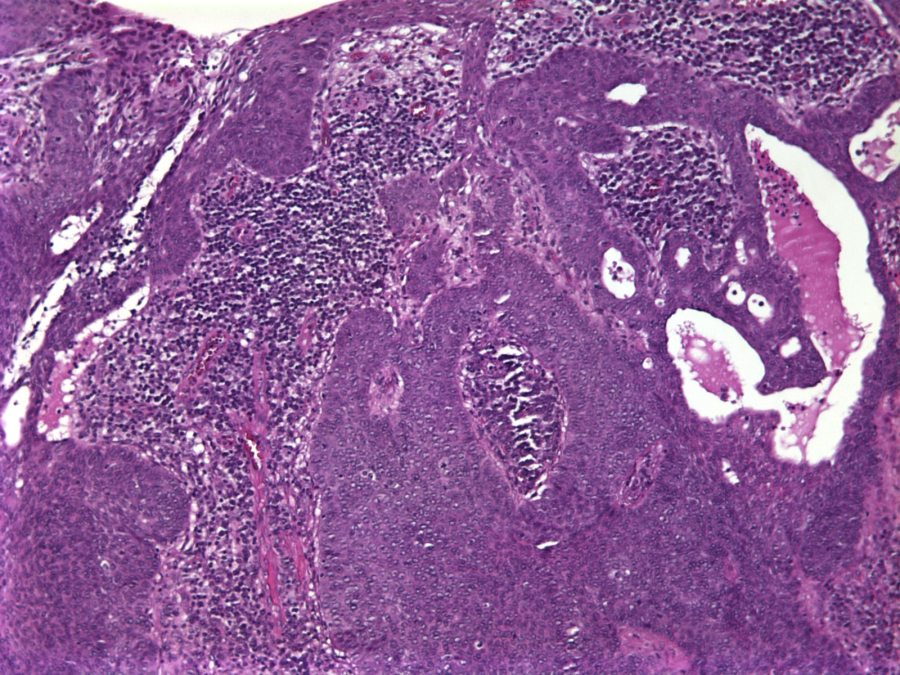 Imagen de Lesión verrucosa en antebrazo / Warty forearm lesion.