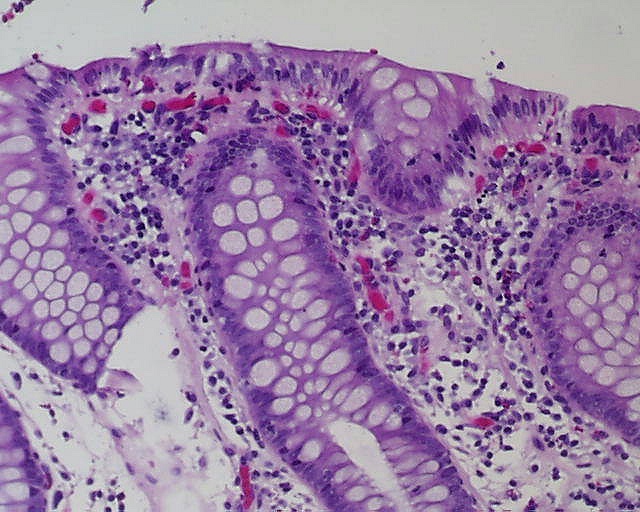 Imagen de Biopsia de colon