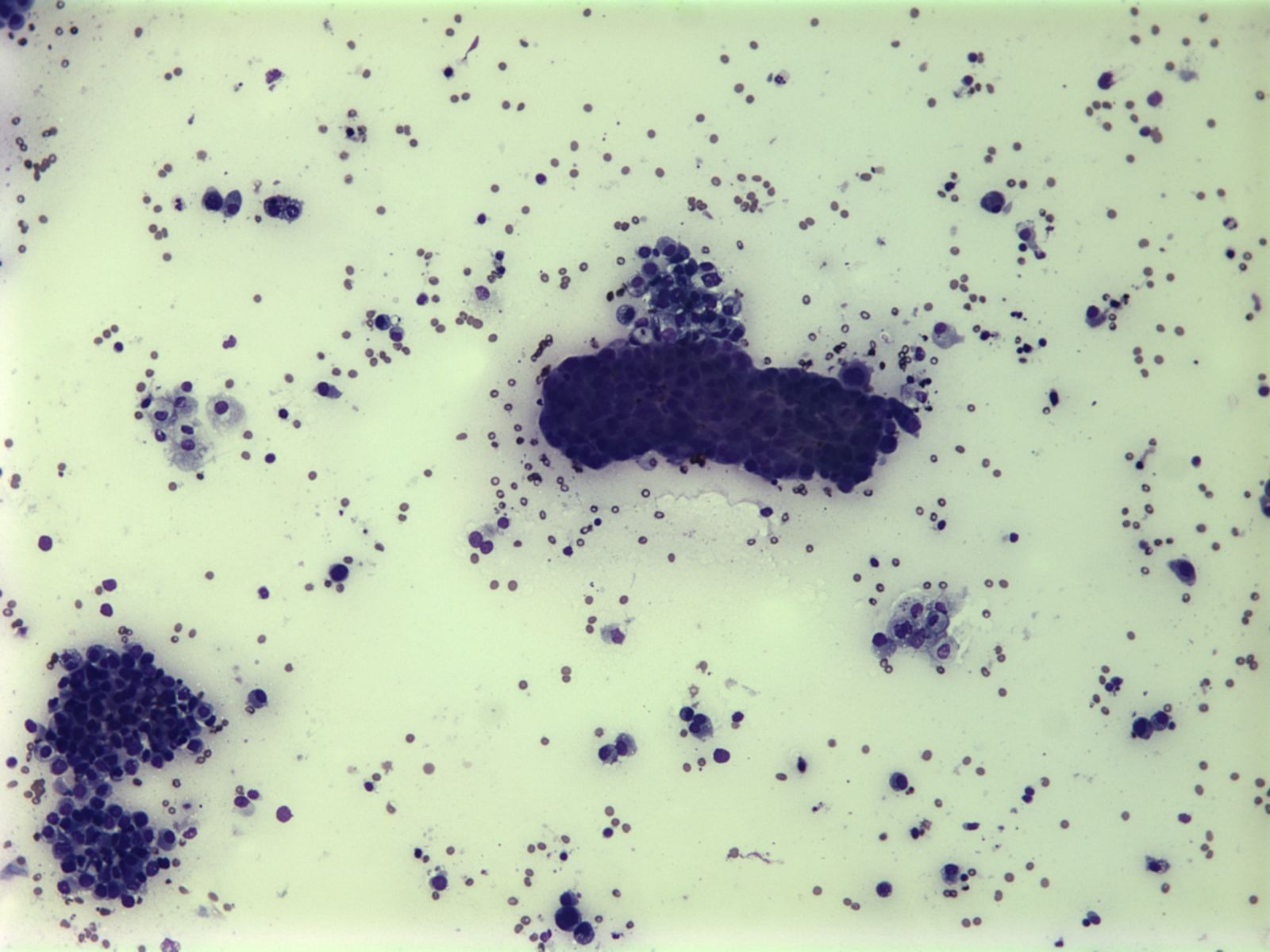 Imagen de Ganglio linfático laterocervical en varón de 70 años/Lateral-cervical lymph node in 70 y-o male.