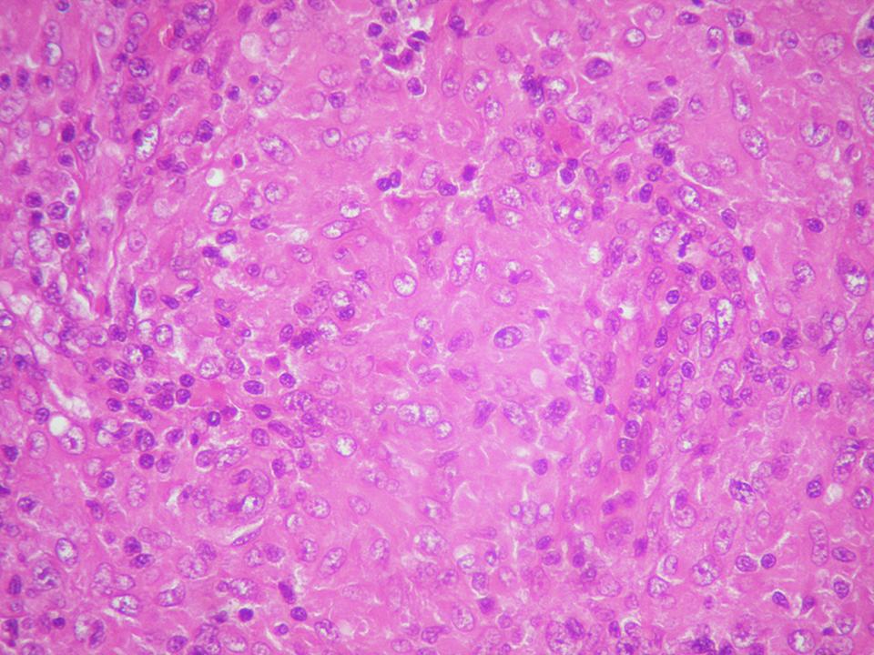 Imagen de Ganglio linfático cervical en mujer de 36 años/Cervical lymph node in 36 y-o female.