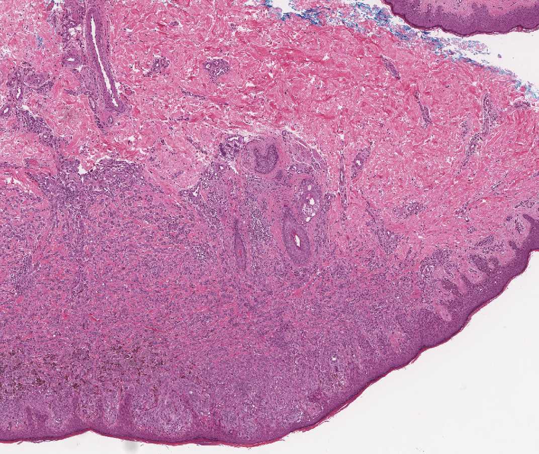 Imagen de Lesión cutánea en mujer de 26 años/Cutaneous lesion in 26 y-o female.