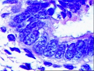 Imagen de leso do colo uterino