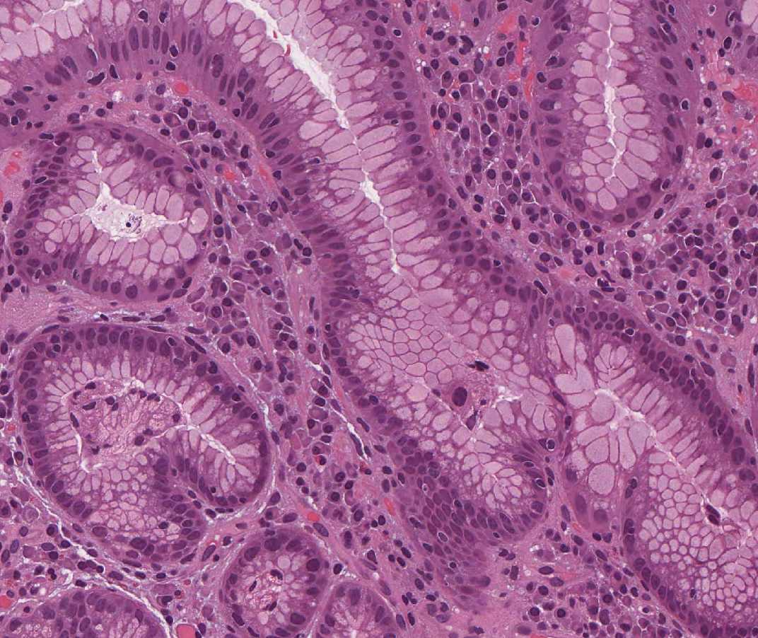 Imagen de Tumoracin gstrica en varn de 74 aos/Gastric tumour in 74 years old male.