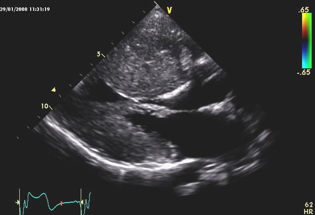 Imagen de Cardiomiopata hipertrfica en nio con sndrome de Noonan/Hypertrophic cardiomyopathy in child with Noonan's Syndrome.