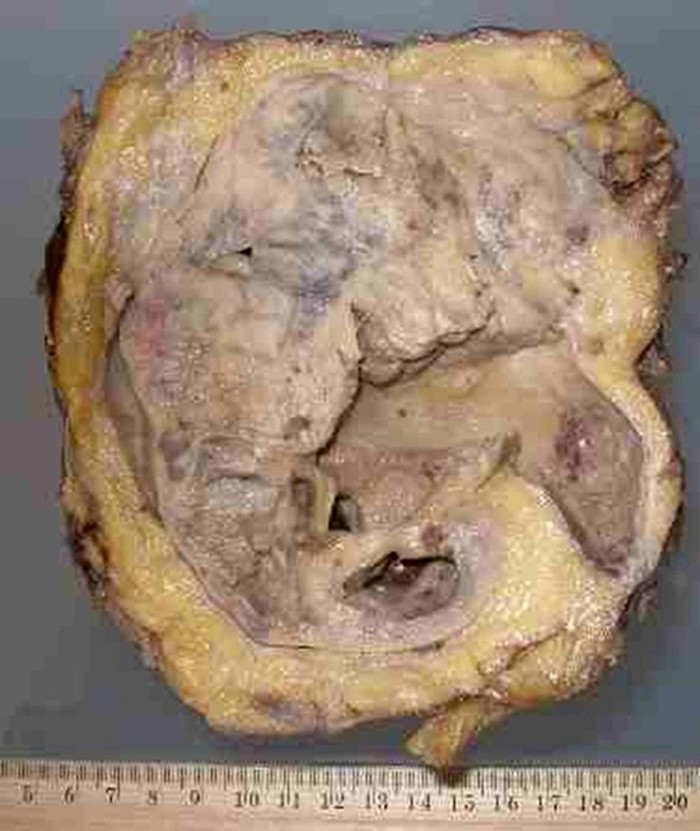 Imagen de Pieza de nefrectoma de varn de 59 aos/Nephrectomy specimen from 59 y-o male.