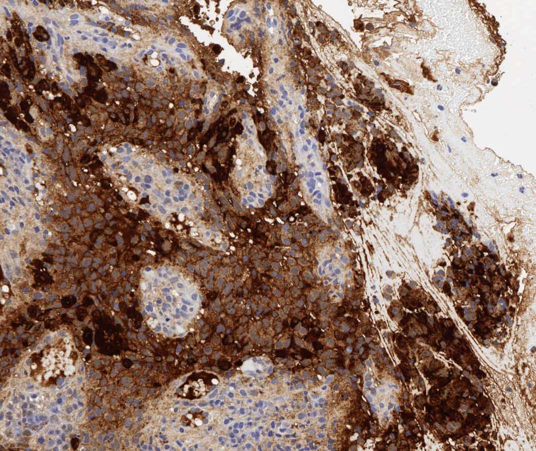 Imagen de Tumor esofgico en varn de 74 aos / Esophageal tumour in 74 y-o male.