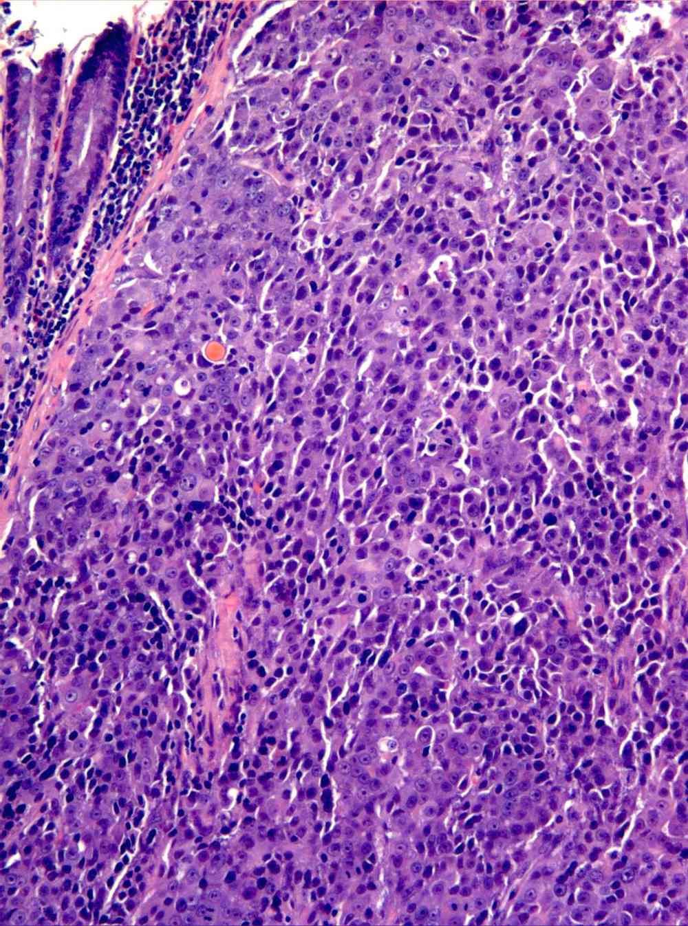 Imagen de Tumor de intestino grueso / Tumour of the large intestine.