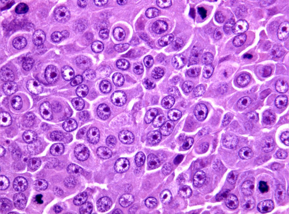 Imagen de Tumor de intestino grueso / Tumour of the large intestine.
