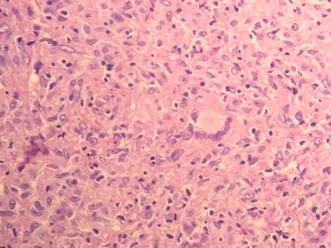 Imagen de Lesin sea y de tejidos blandos en varn de 57 aos / Bone and soft tissue lesion in 57 y-o male.