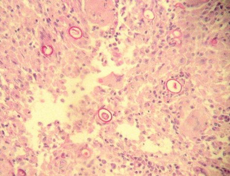 Imagen de Lesin sea y de tejidos blandos en varn de 57 aos / Bone and soft tissue lesion in 57 y-o male.