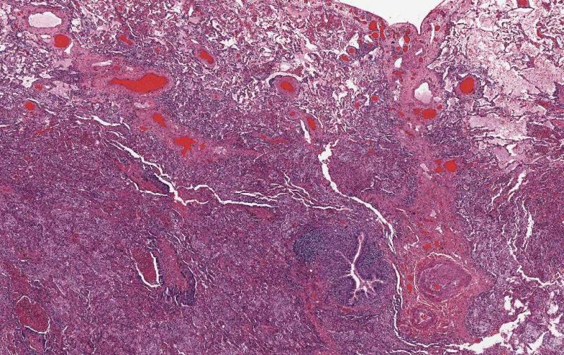 Imagen de Infiltrados alveolares parcheados bilaterales en mujer de 71 aos / Patchy alveolar infiltrates in 71 y-o female.