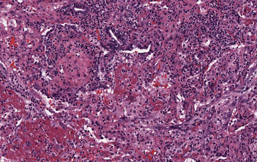 Imagen de Infiltrados alveolares parcheados bilaterales en mujer de 71 aos / Patchy alveolar infiltrates in 71 y-o female.