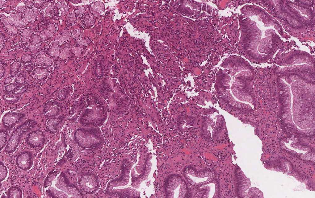 Imagen de Placas rojizas en estmago/Reddish patches in stomach.