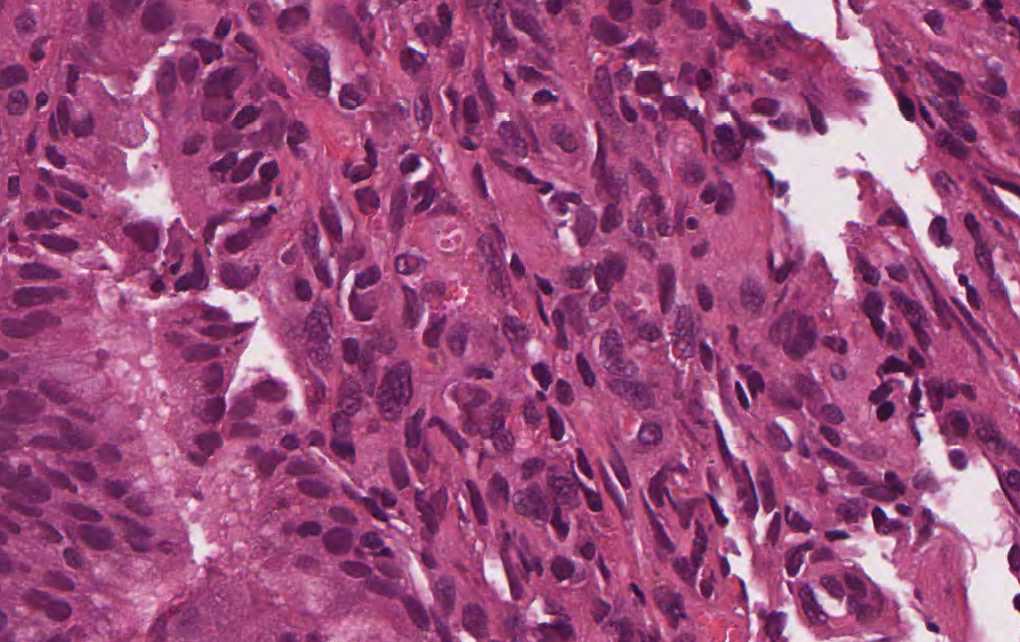 Imagen de Placas rojizas en estmago/Reddish patches in stomach.