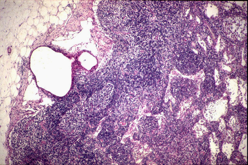 Imagen de Ganglio linftico de una reseccin anterior por adenocarcinoma rectal / Lymph node from intestinal resection for rectal adenocarcinoma.