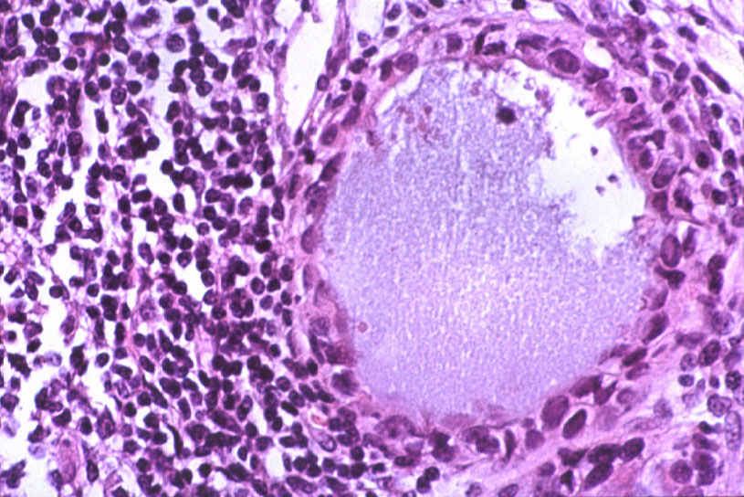 Imagen de Ganglio linftico de una reseccin anterior por adenocarcinoma rectal / Lymph node from intestinal resection for rectal adenocarcinoma.