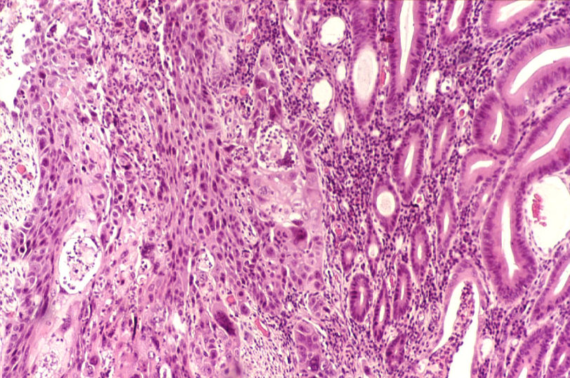 Imagen de Tumor de intestino grueso / Large intestine tumour.