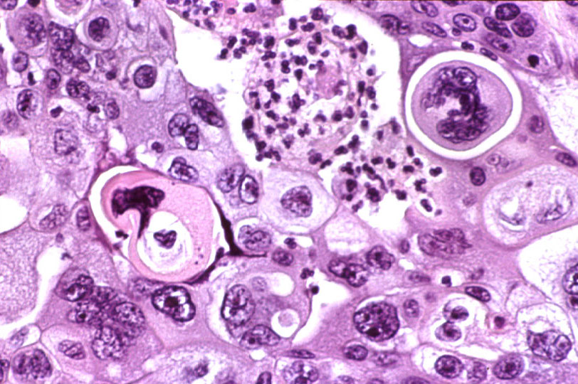 Imagen de Tumor de intestino grueso / Large intestine tumour.