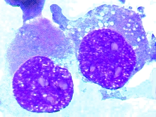 Imagen de Clulas no sangue perifrico
