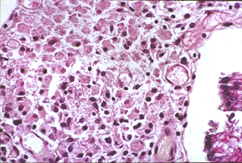 Imagen de Lesin de la mucosa gstrica/Gastric mucosal lesion.