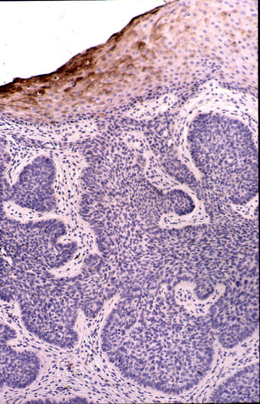 Imagen de Tumor ulcerado del margen anal/Ulcerated tumour on the anal margin.