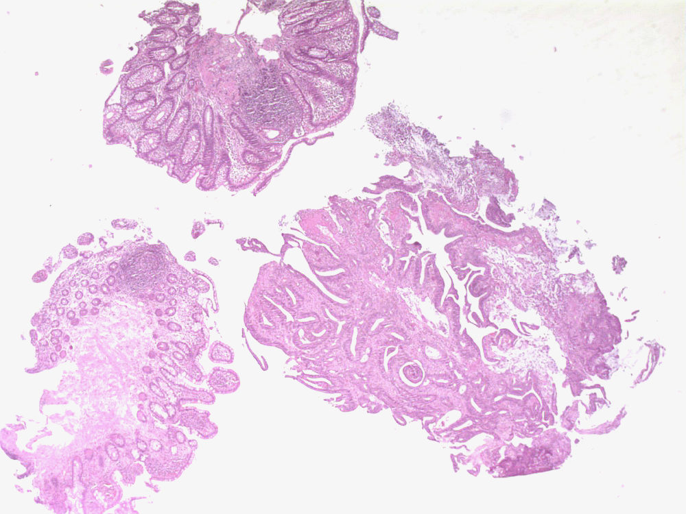 Imagen de Biopsia de colon / Colonic biopsy.