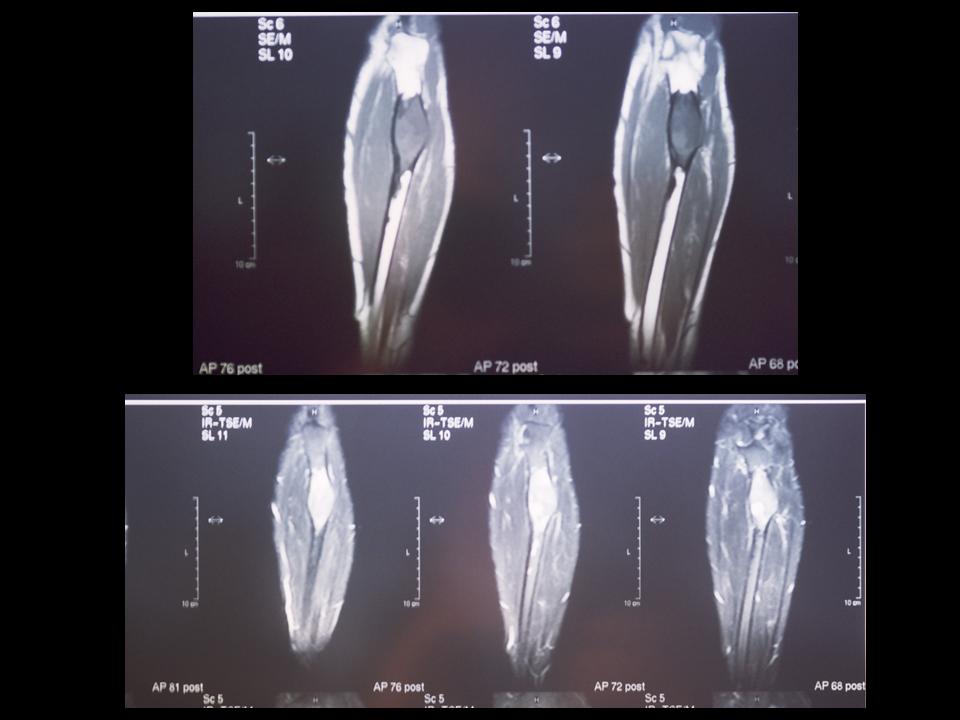 Imagen de Tumor seo en el codo izquierdo/Bone tumour in the left elbow.