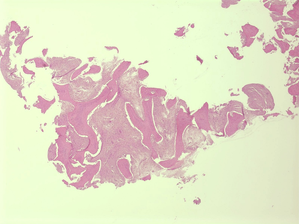 Imagen de Tumor seo en el codo izquierdo/Bone tumour in the left elbow.