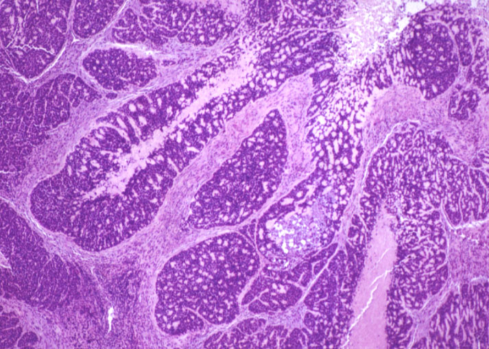 Imagen de Tumor de esfago distal/Tumour of the distal esophagus.