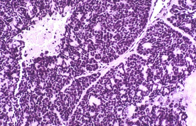 Imagen de Tumor de esfago distal/Tumour of the distal esophagus.